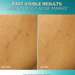 Dark Spot Exfoliant Peel for Reducing Dark Spots & Brightening Skin